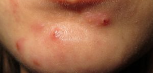 Cystic acne on chin - deep