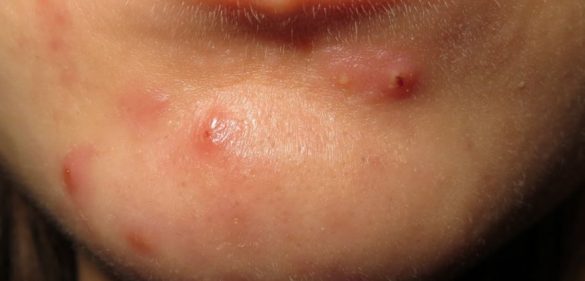 Cystic Acne on Chin: Deep Painful Causes & Treatments | Skincarederm