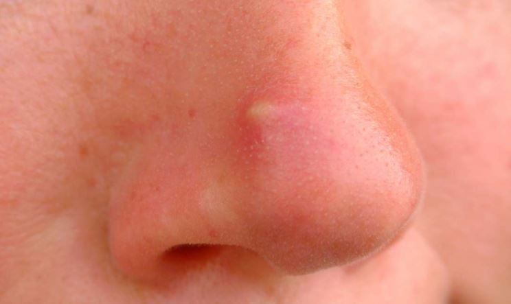 Pimple bump on nose