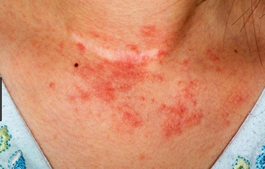 What Causes Rashes In Babies Neck