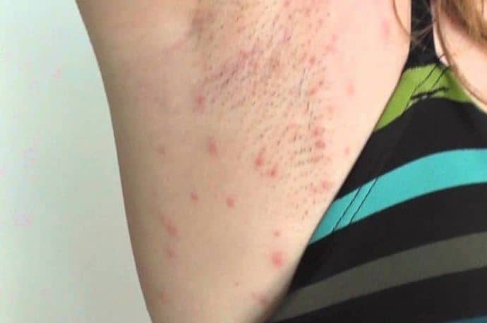 Razor bumps on armpit after shaving