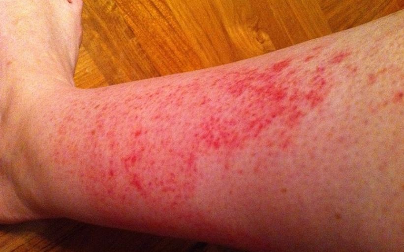 Red rash on leg - may be itchy, bumpy, scaly depending on cause