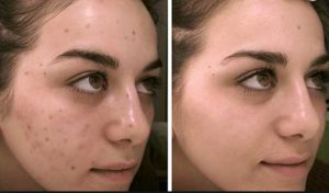 Acne dark spots before and after removal