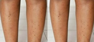 Acne dark spots on legs