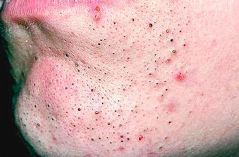 Blackheads on chin and around mouth