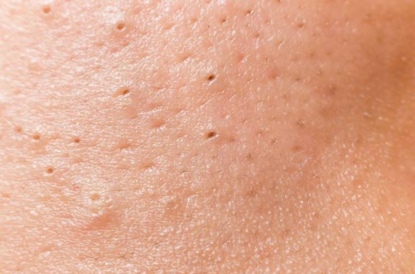 Blackheads on Legs and Thighs Causes and Treatment ...