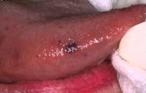 Dark spots on side of tongue