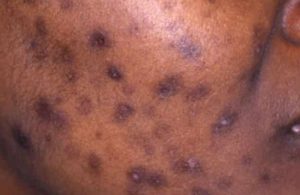 Dark spots on skin - Dark acne scars