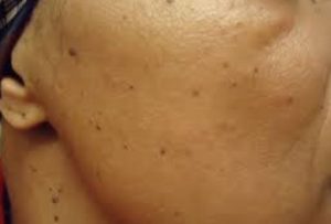 Dark spots on skin - Facial dark or black marks