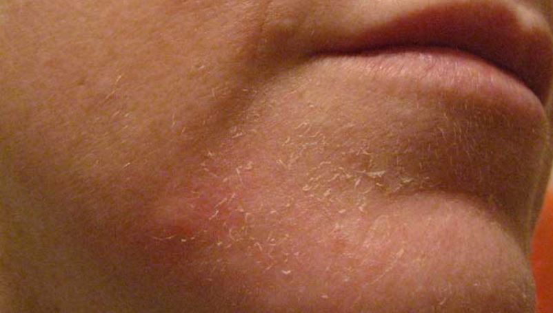 Dry flaky skin on chin or face