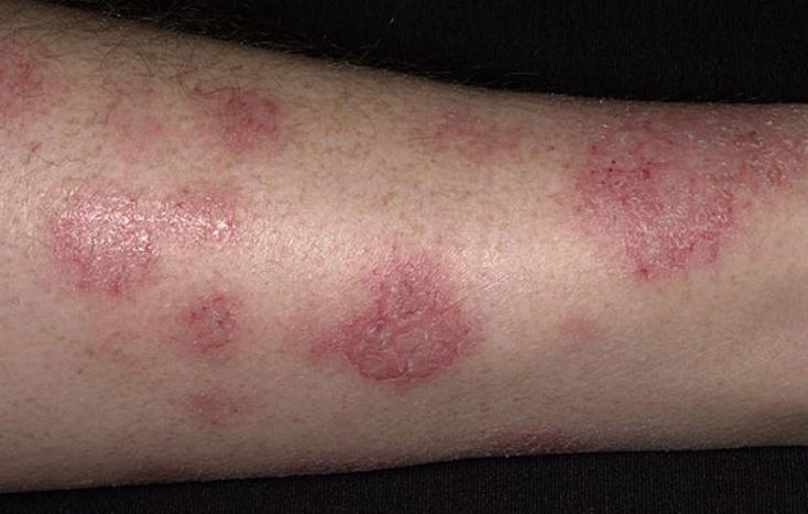 Red Round Dry Patch On Leg