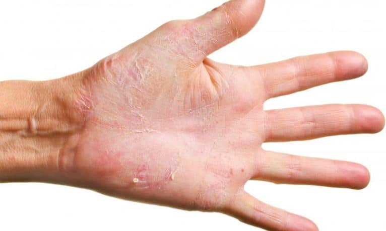 prevent-and-treat-dry-cracked-hands-university-health-news