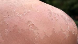 Extreme peeling itchy sunburn relief