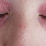 Dry Skin Around Eyes or Eyelids Causes and Treatments