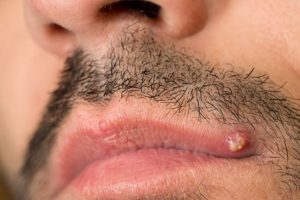 Lip pimple on upper lip line