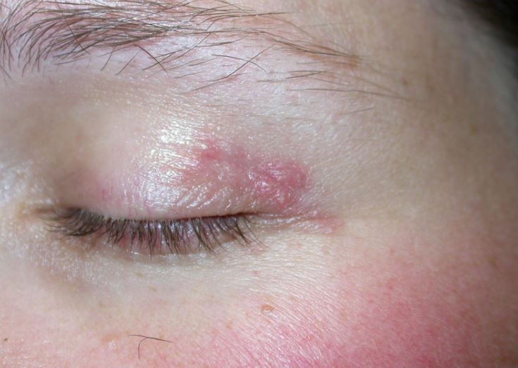 Perioral dermatitis around eyes