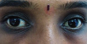 Periorbital Hyperpigmentation dark spots under eyes