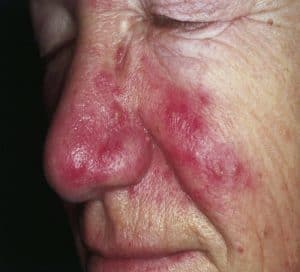 Redness around nose due to rosaea - Courtesy of Medical News Today