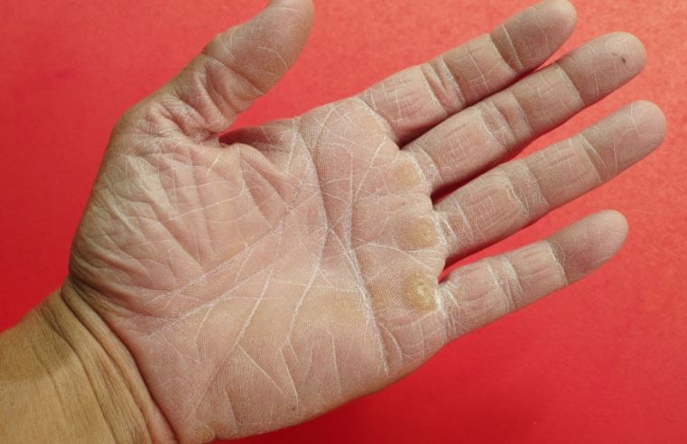 Rough dry skin on hands
