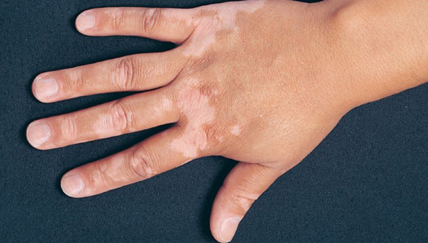 White Patches On Hands Due To Vitamin Deficiency