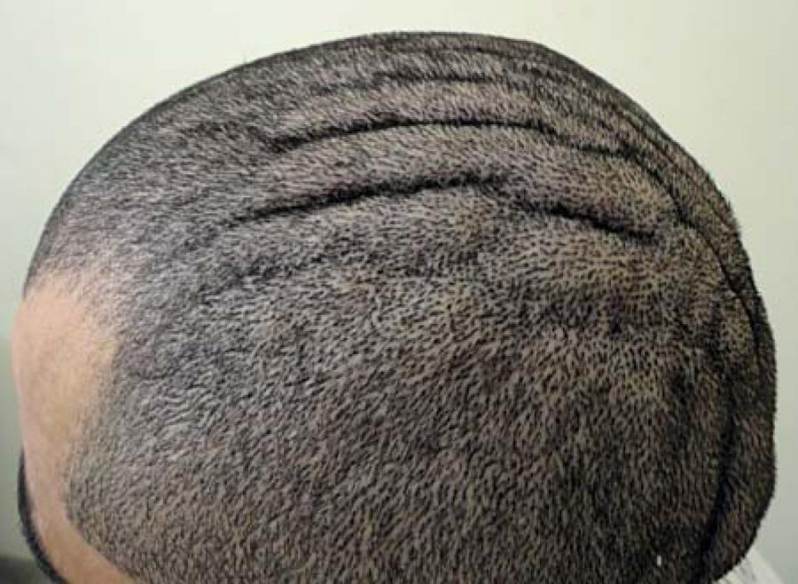 Wrinkled scalp