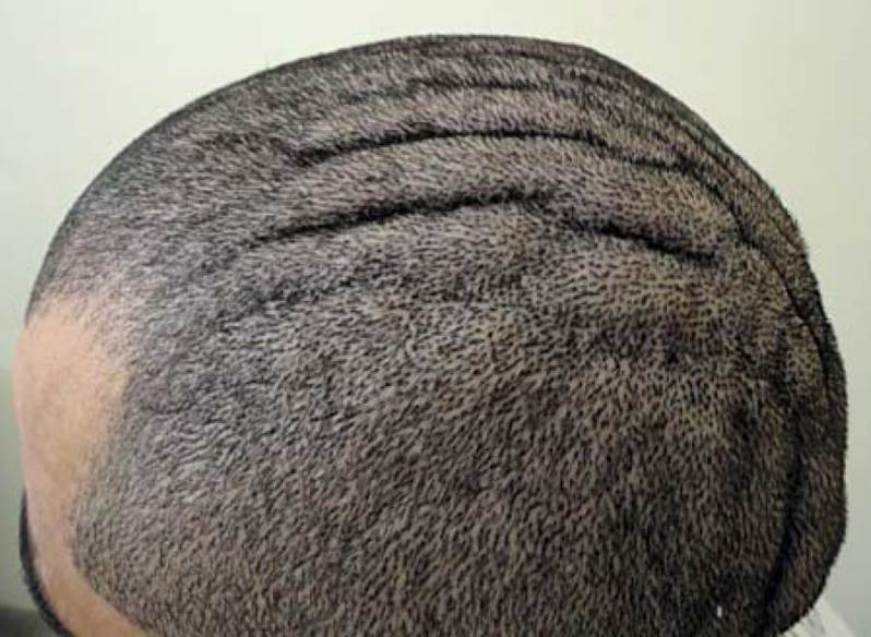 wrinkled-scalp-meaning-causes-and-treatments-skincarederm