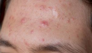 Forehead pimple or acne