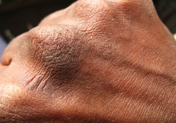 Cracked knuckle skin image