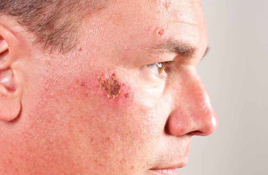 causes-of-scabs-on-face-and-fast-treatment-ways-skincarederm