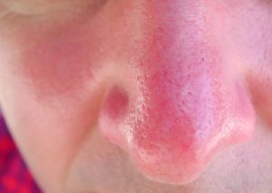 Sunburned nose - expect peeling at times