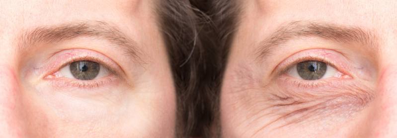 Under eye wrinkles after and before treatment