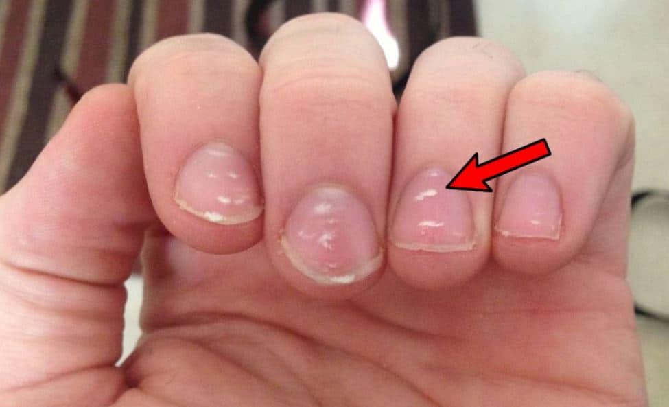 white-patches-on-fingernails