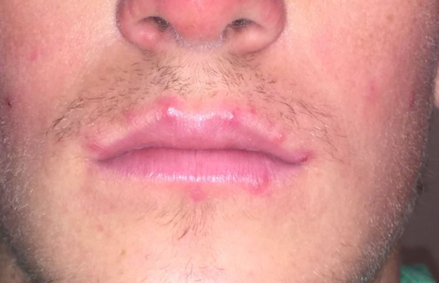 Acne around mouth - on lip and lip line edges