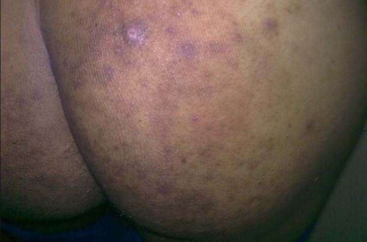 Dark spots on buttocks