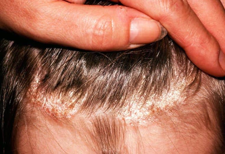 Causes of Dry Patches on Scalp and Treatments - Skincarederm