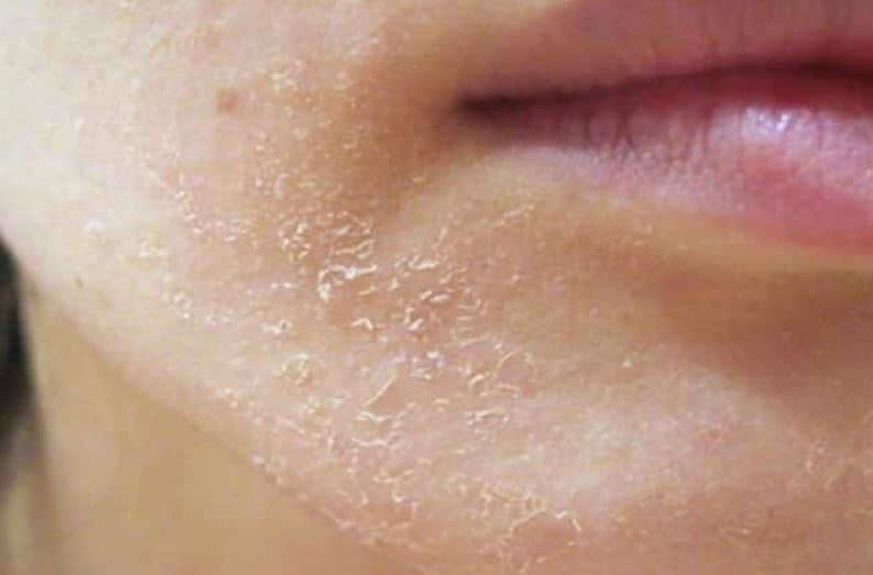 6-causes-of-dry-skin-on-chin-and-treatment-remedies-skincarederm