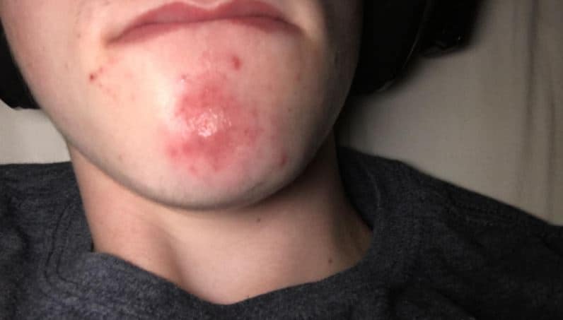 Large Red Spot On My Face