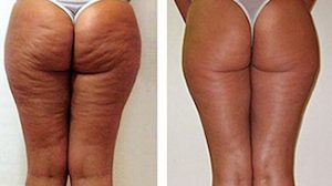 Cellulite removal before and after