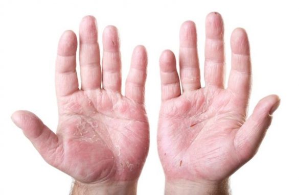 itchy hands in cold weather