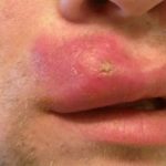 How to Get Rid of Cystic Big Painful Swollen Pimple