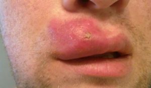 Big swollen pimple on upper lip