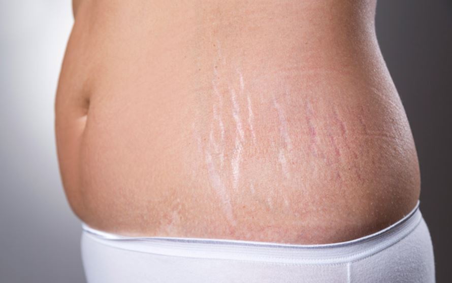 Stretch mark scars due to pregnancy